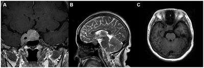 IgG4-associated hypophysitis coexisting with MALT lymphoma and gangliocytoma: first case report and literature review